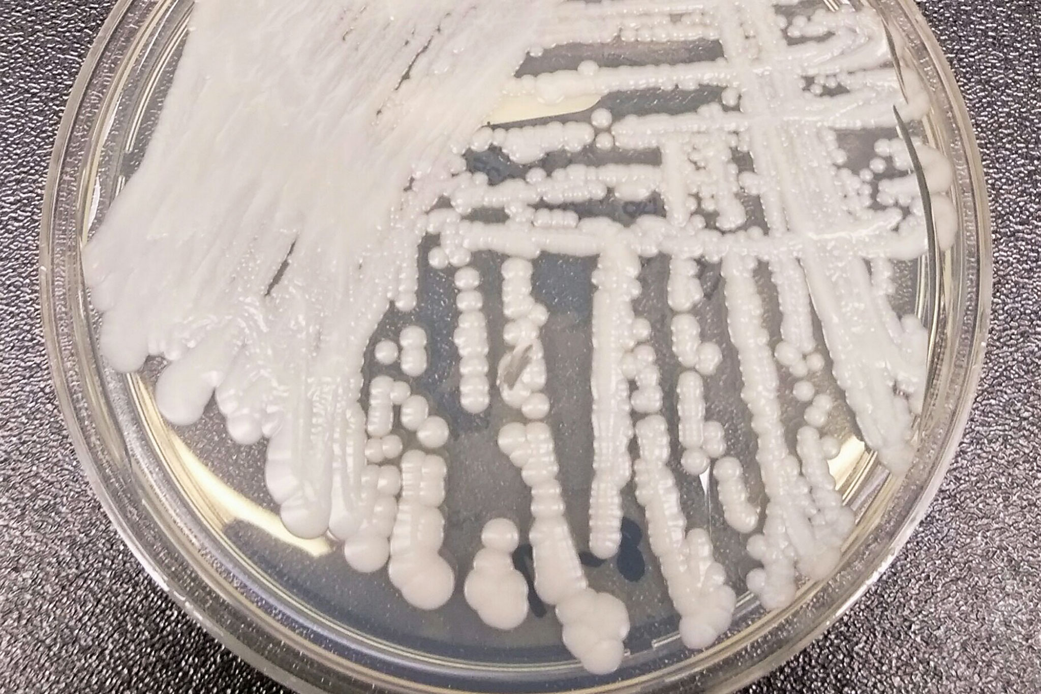 35 Americans stricken with severe fungal infection, says CDC