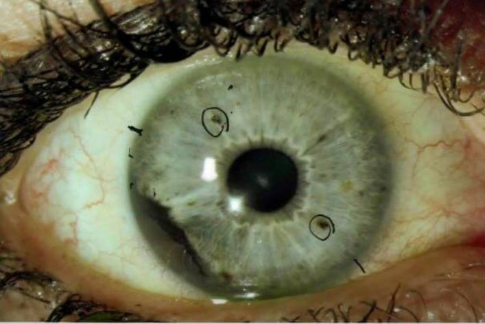 Cluster of Ocular Melanoma among former Auburn students garners interest of eye care community