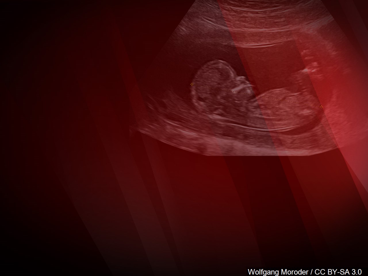 Alabama House approves 'born alive' abortion bill