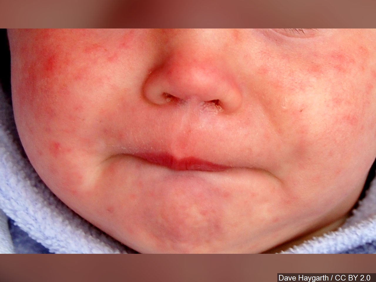 Confirmed case of measles in St. Clair County infant